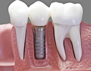 Cutaway diagram showing dental implants next to normal teeth
