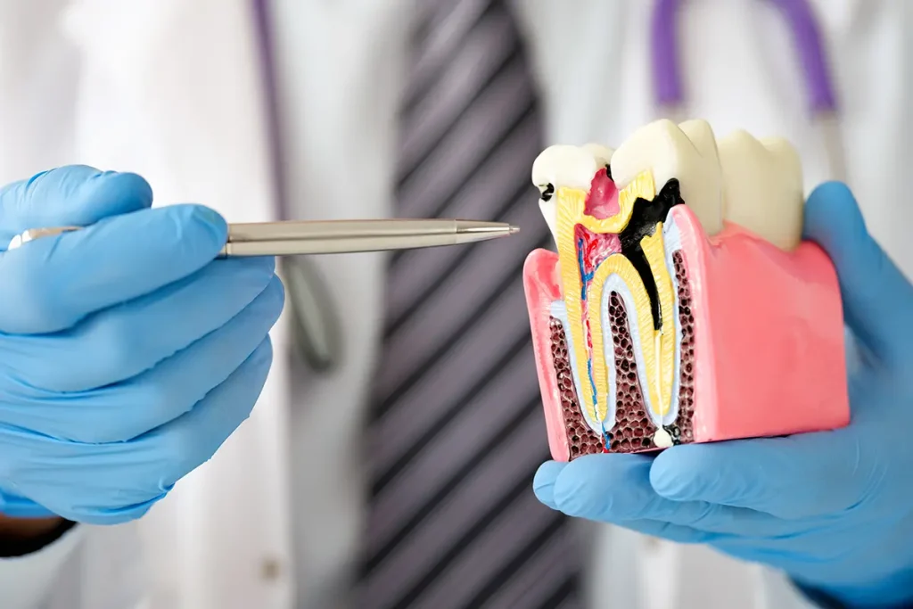 Dentist showing cavities on tooth model