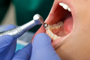 Professional dental cleaning at Eubanks family dental